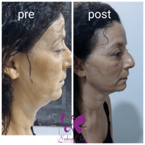 قبل و بعد الخيوط التجميلية